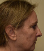 Rhinoplasty