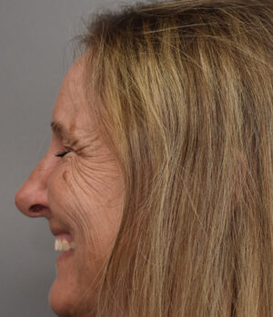 Rhinoplasty