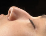 Rhinoplasty